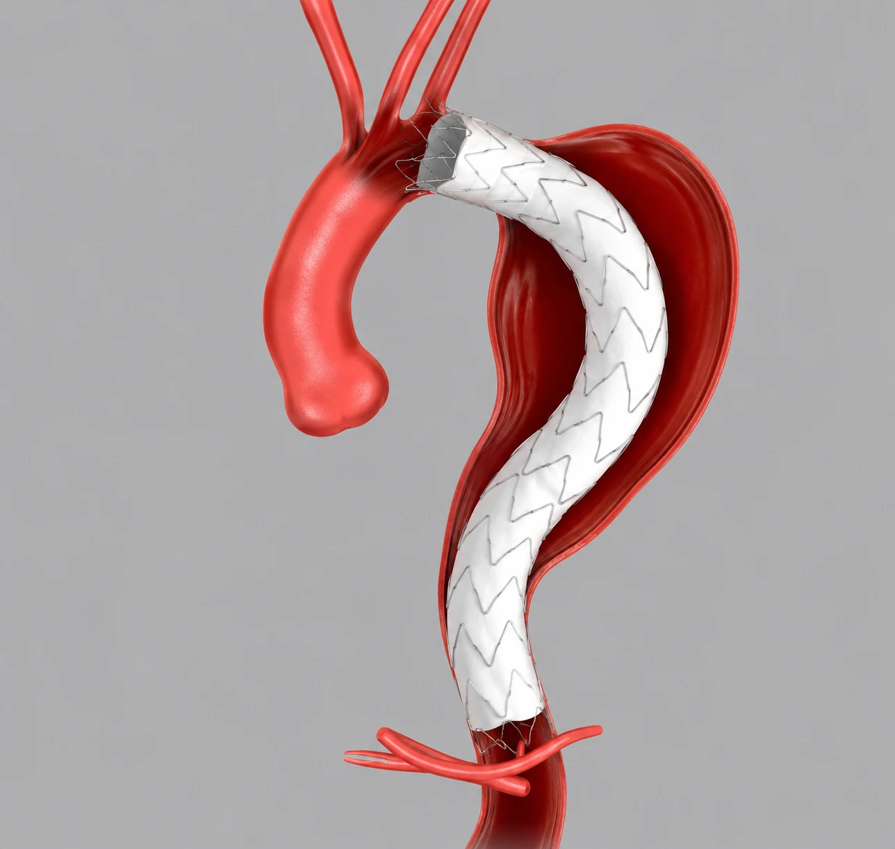 Khung giá đỡ động mạch vành hãng Cook medical của Mỹ/ Stent